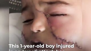 Injured Gaza 1-year-old suffers 200 facial stitches and hand amputation _ Al Jazeera Newsfeed.