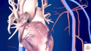 Heart catheterization