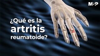 Otra de la actritis