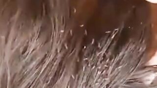 Lice in hair