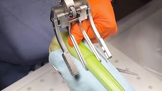 Achilles Tendon Repair Demonstration