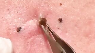 Blackheads removing