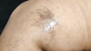 Leech theraphy