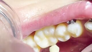 Dental scaling and polishing