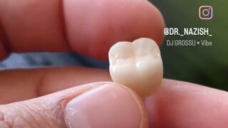 Zirconia crown.