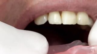 Removable partial denture