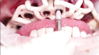 Dental implants
