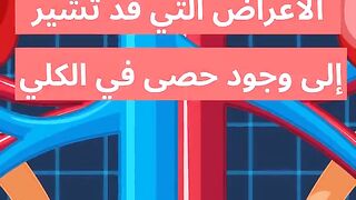 أعراض حصى الكلي-Symptoms Of Kidney Stones