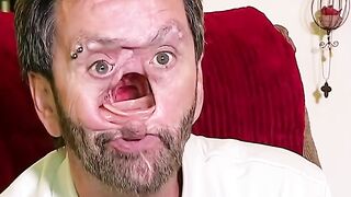 Man receives new face from skilled doctors  His wife stayed with him. Thats unconditional love❤️