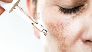 Melasma | Best treatment for melasma on face #mix #melasmatreatment