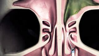Balloon Sinuplasty Procedure 3D Animation