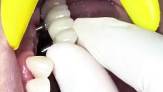 Dental installation amazing????????