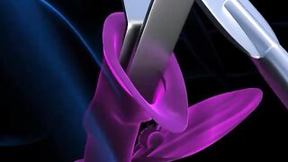 Hysterectomy Procedure 3D Animation