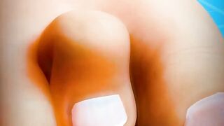 How To Fix Hammertoe ????