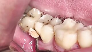How to Clean and Deodorize Dentures to Improve Oral Hygiene"