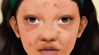 ASMR Big Blackhead and Acne Removal Animation  Pimple Removal