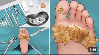 Asmar surgery foot ????