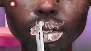 Treating chapped lips