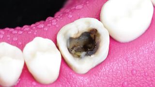 INCREDIBLE Reconstruction Of Poor_Failed Root Canal Treated Tooth..