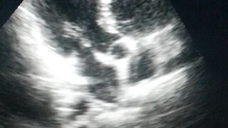 Echocardiography