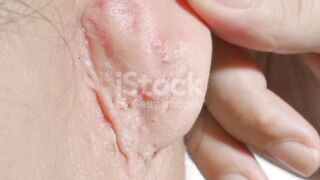 BLACKHEADS IN EARS