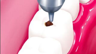 Fill cavities