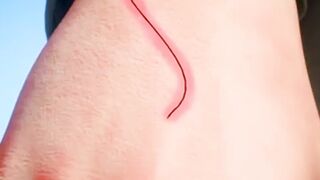 Hair Under Your Skin? The Mystery of the Splinter
