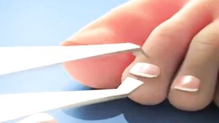 Toenail Removal: When is it Necessary and How is it Done?