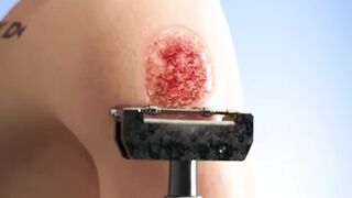 Borrowing Skin: The Magic of Skin Grafts