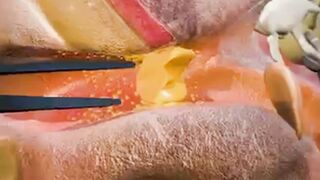 Earwax: Friend or Foe? A Guide to Safe and Effective Removal