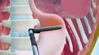 Gastric Bypass: A Weight Loss Solution
