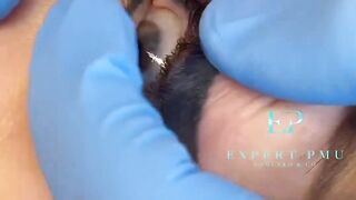 Laser tattoo removal 2
