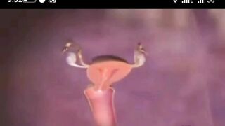 Le syndrome de Down