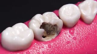 AMAZING reconstruction of tooth damaged by caries: Endodontics