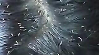 Picking A Thousand Of Lice on Hair| How To Remove Lice