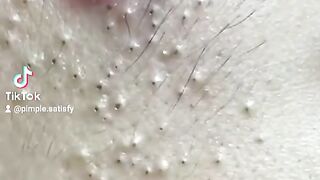 Super satisfied ???? blackheads removal