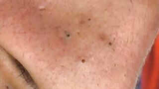 Amazing ???? video ,full blackheads
