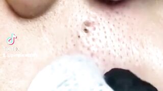 Geant blackheads removal ❤️
