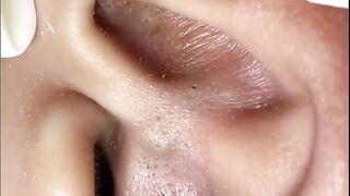 Big blackhead removal ❤️