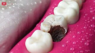ASMR Restoration! Incredible Tooth Cavity And The Master Dentist