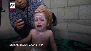 Lice, scabies, rashes plague Palestinian children as skin disease runs rampant in Gaza’s tent camps.