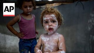 Lice, scabies, rashes plague Palestinian children as skin disease runs rampant in Gaza’s tent camps