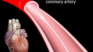 Stent in Heart