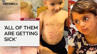 Palestinian parents desperately seek help for children’s skin diseases