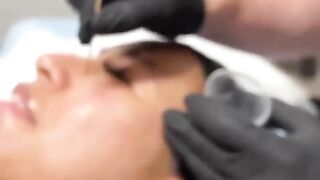 ACNE SCAR COMBINATION | HYBRID LASER + CO2 ABLATIVE | Dr. Jason Emer
