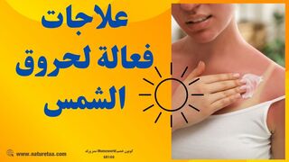 وصفات لعلاج حروق الشمس