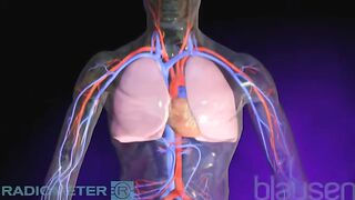 Pulmonary Embolism