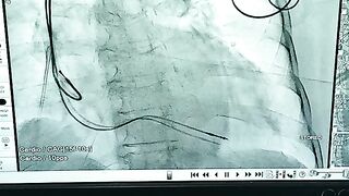 Pacemaker placement on human body