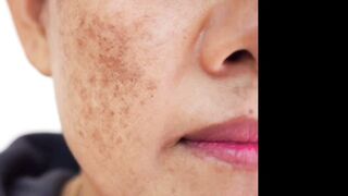 মেসতা সমস্যা সহ ফর্সা হওয়ার জন্য এই ক্রিম