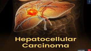 Hepatocellular Carcinoma (HCC) | Understanding Liver Cancer | Screening and Diagnosis